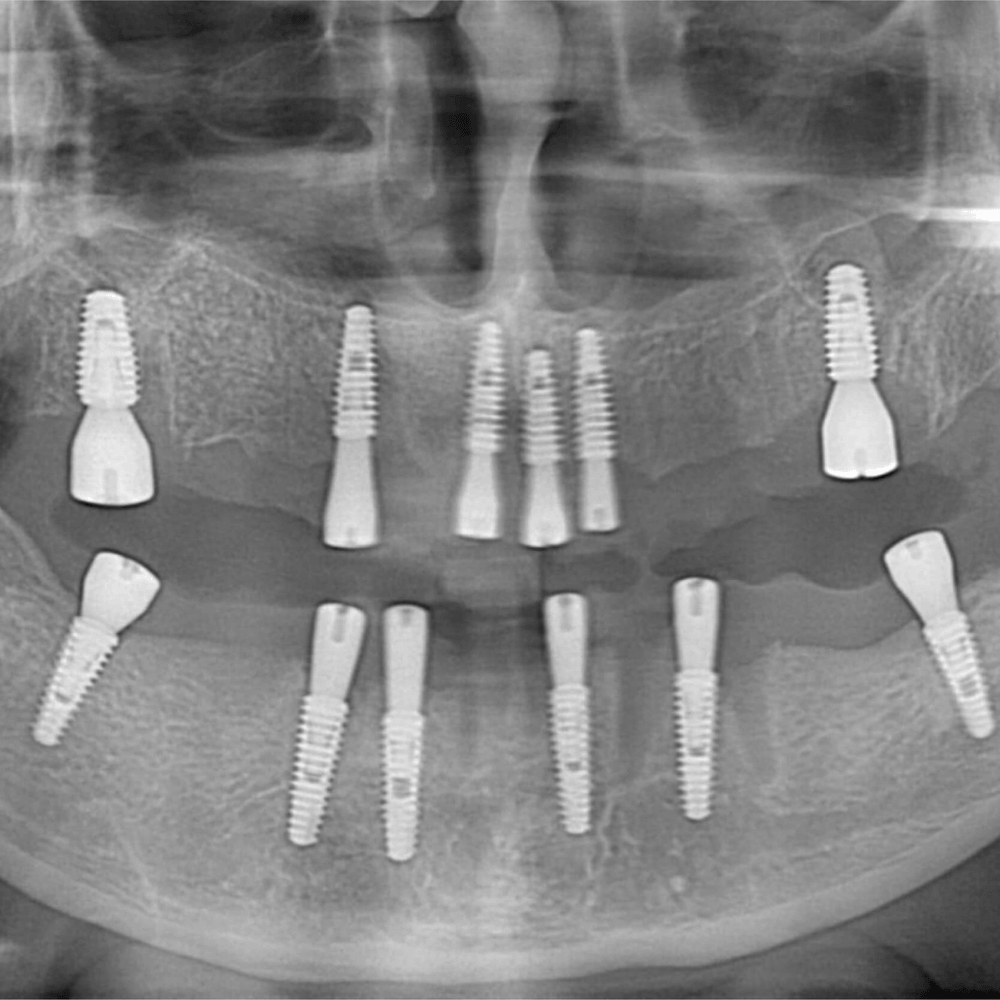 All-on-6 Dental Implant Treatment