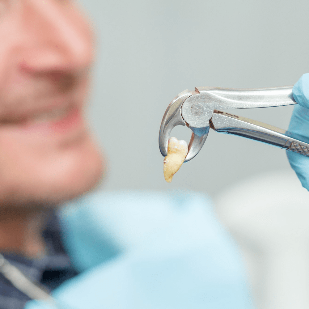 Tooth Extraction