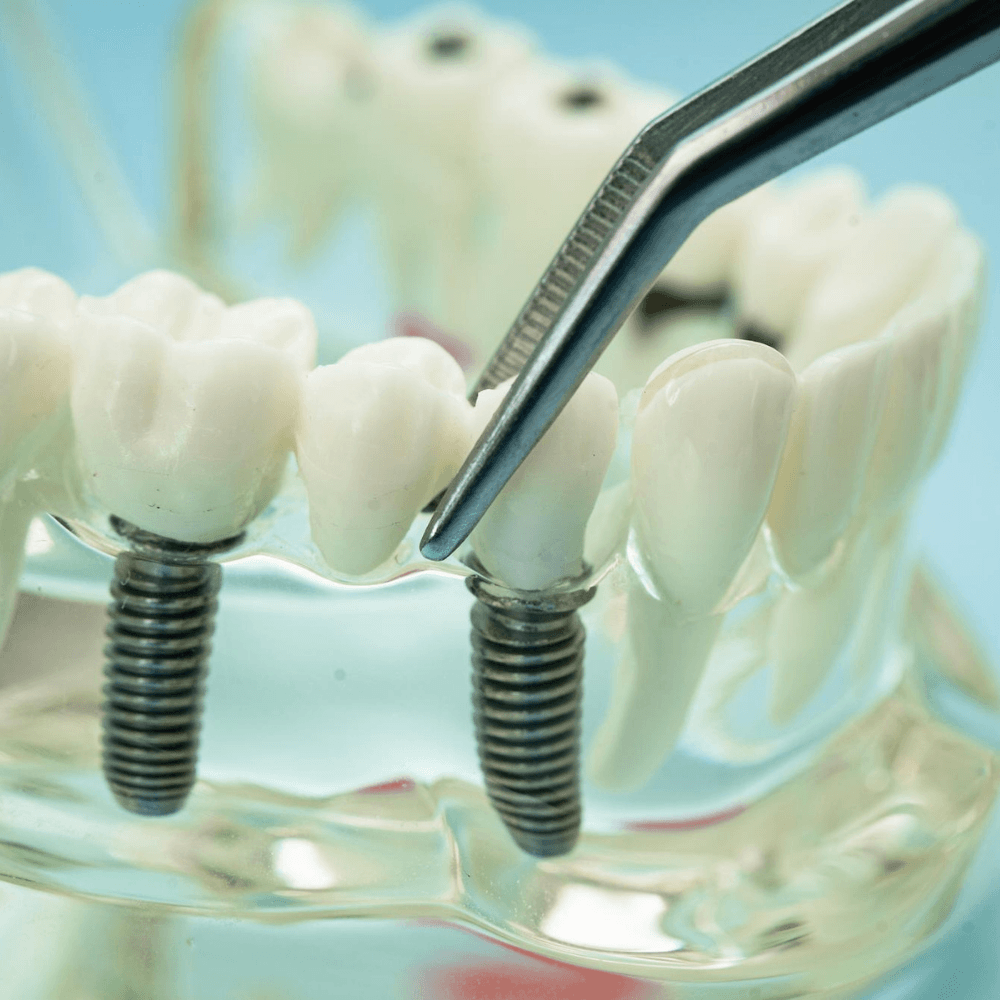 Dental Implant Treatment