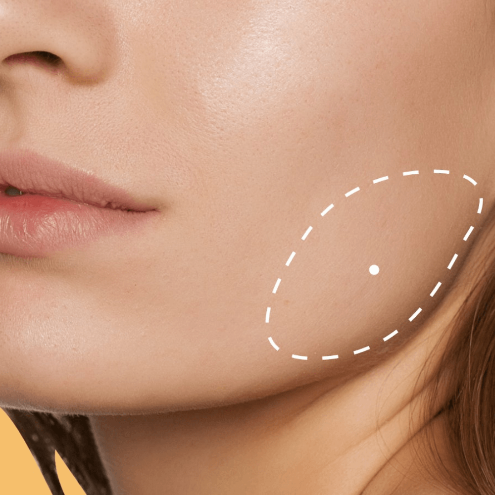 Masseter Botox