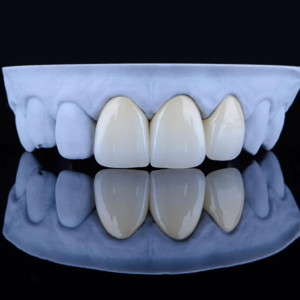 Zirconia Crown Model