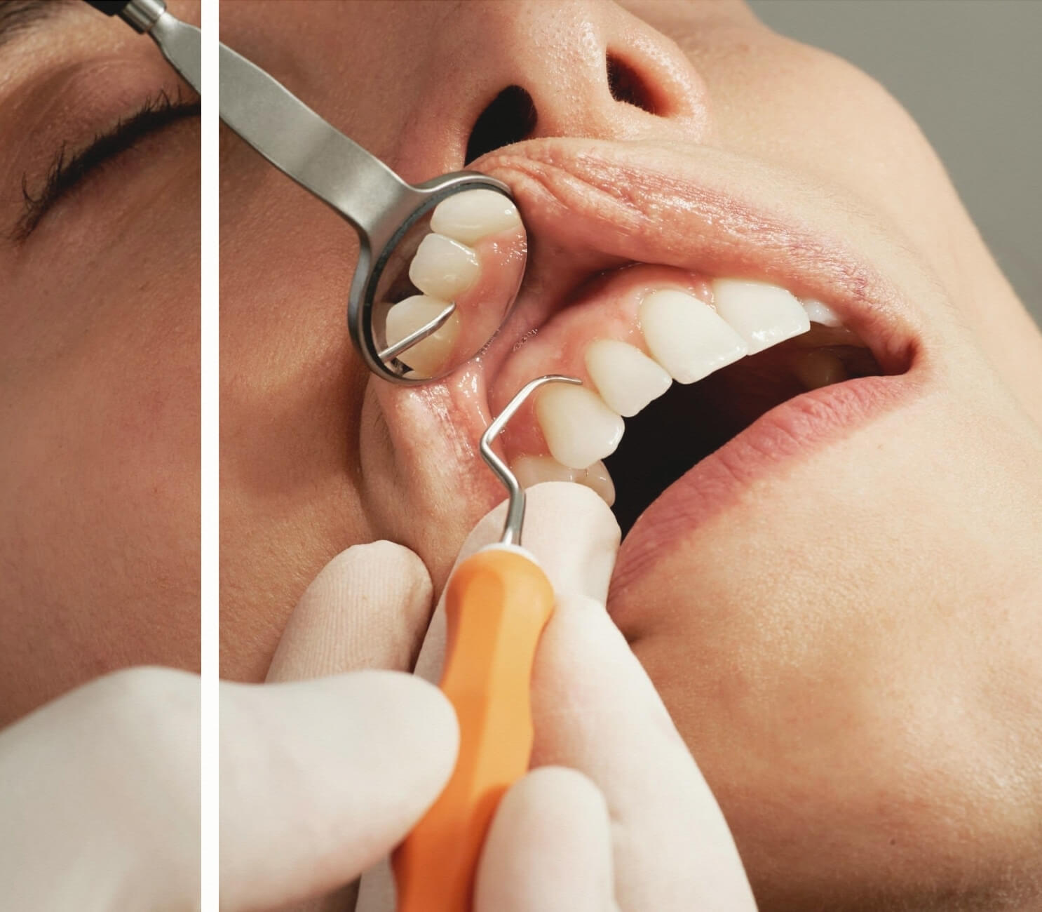 Derin Diş Taşı Temizliği Küretaj