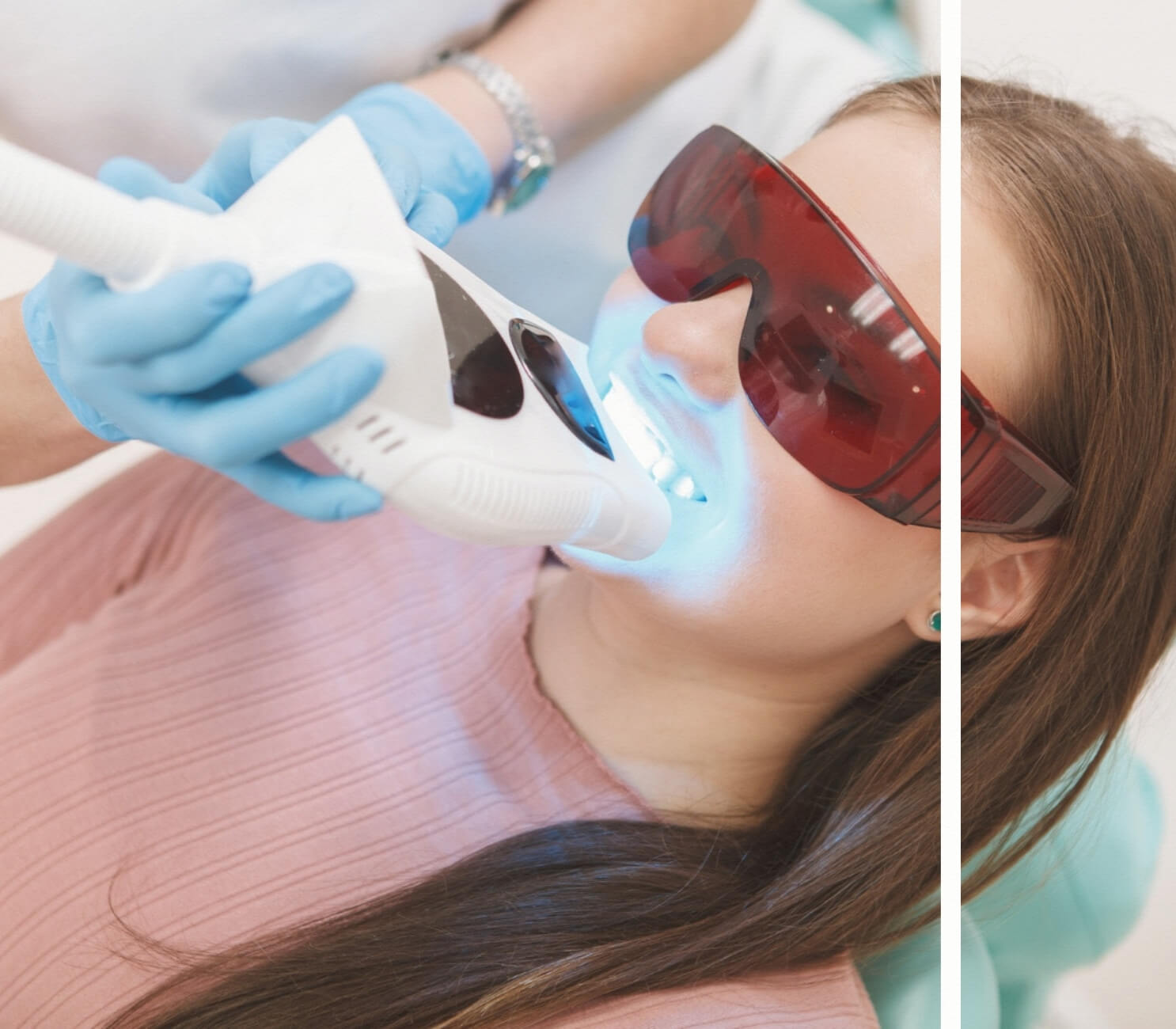 Diş Beyazlatma Lazer ile Uygulama