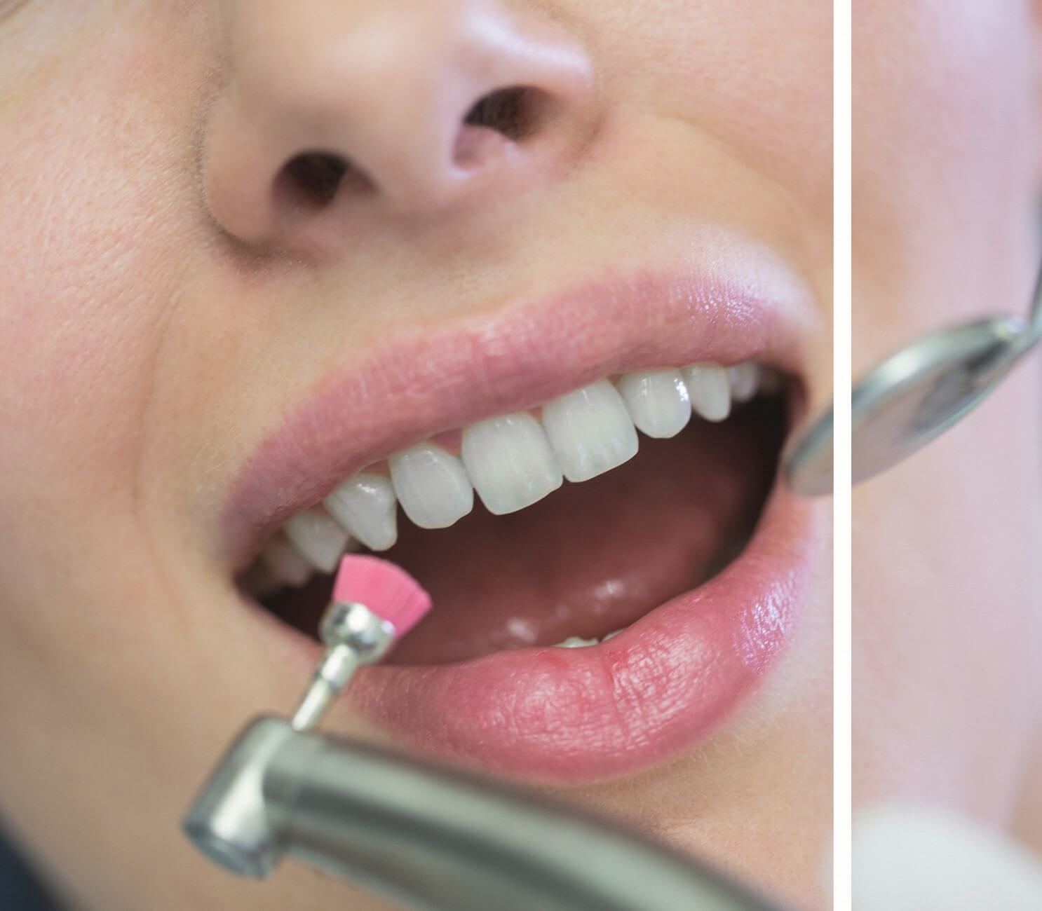 Diş Taşı Sonrası Polisaj Cila