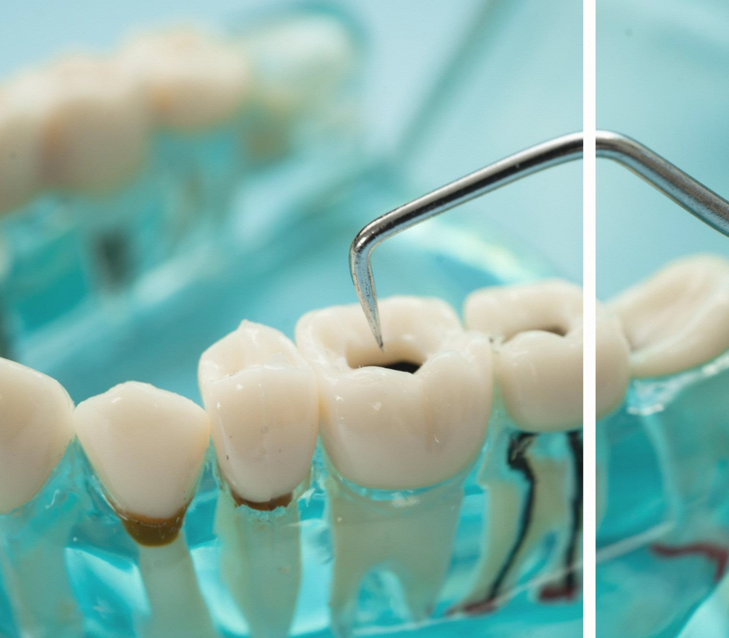 Dişe Dolgu Yapılması