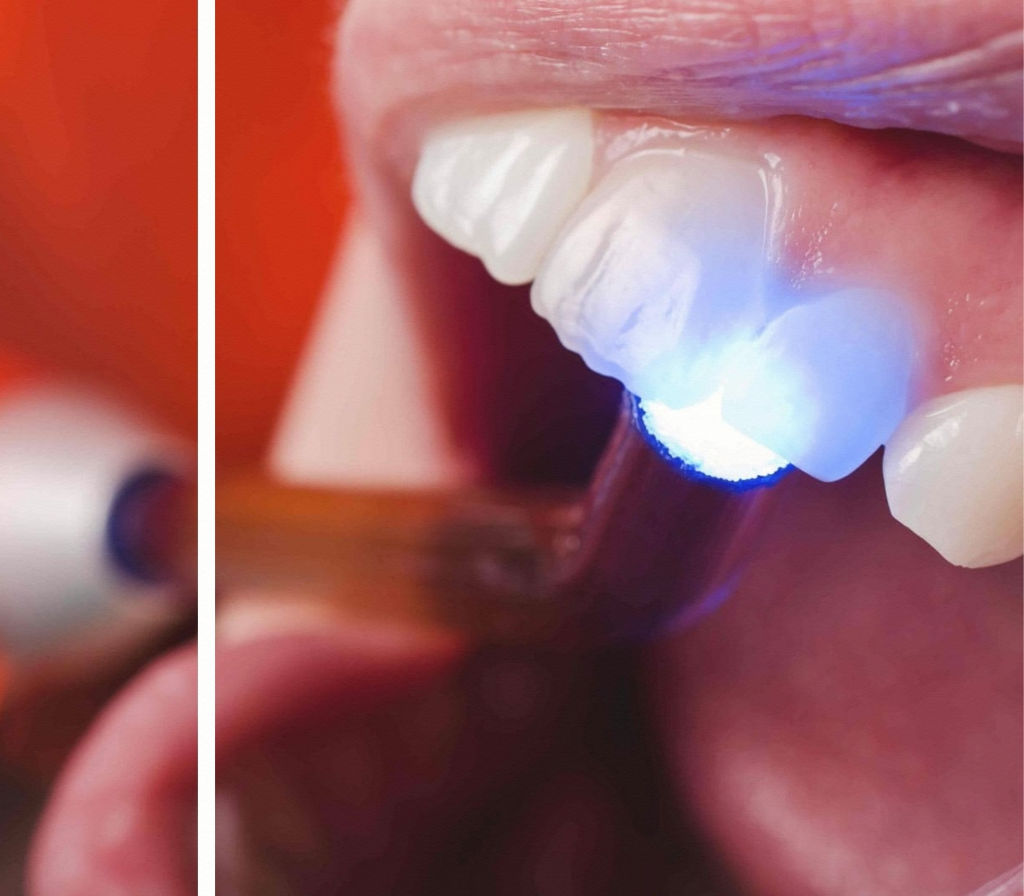 Estetik Ön Bölge Dolgu