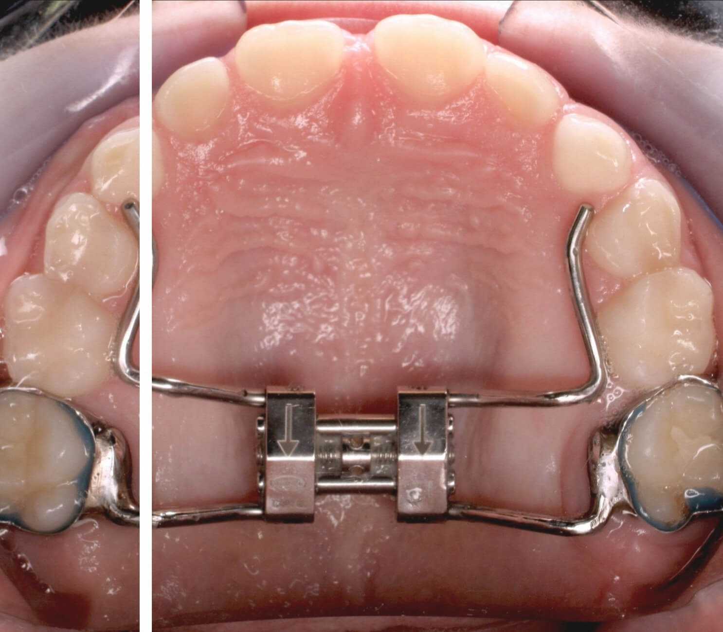 Hyrax Apareyi - Sarpe