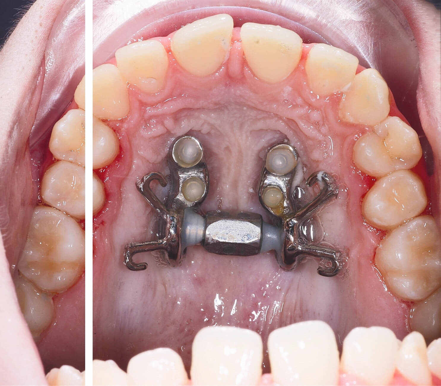 Marpe (Ameliyatsız Üst Çene Genişletme)
