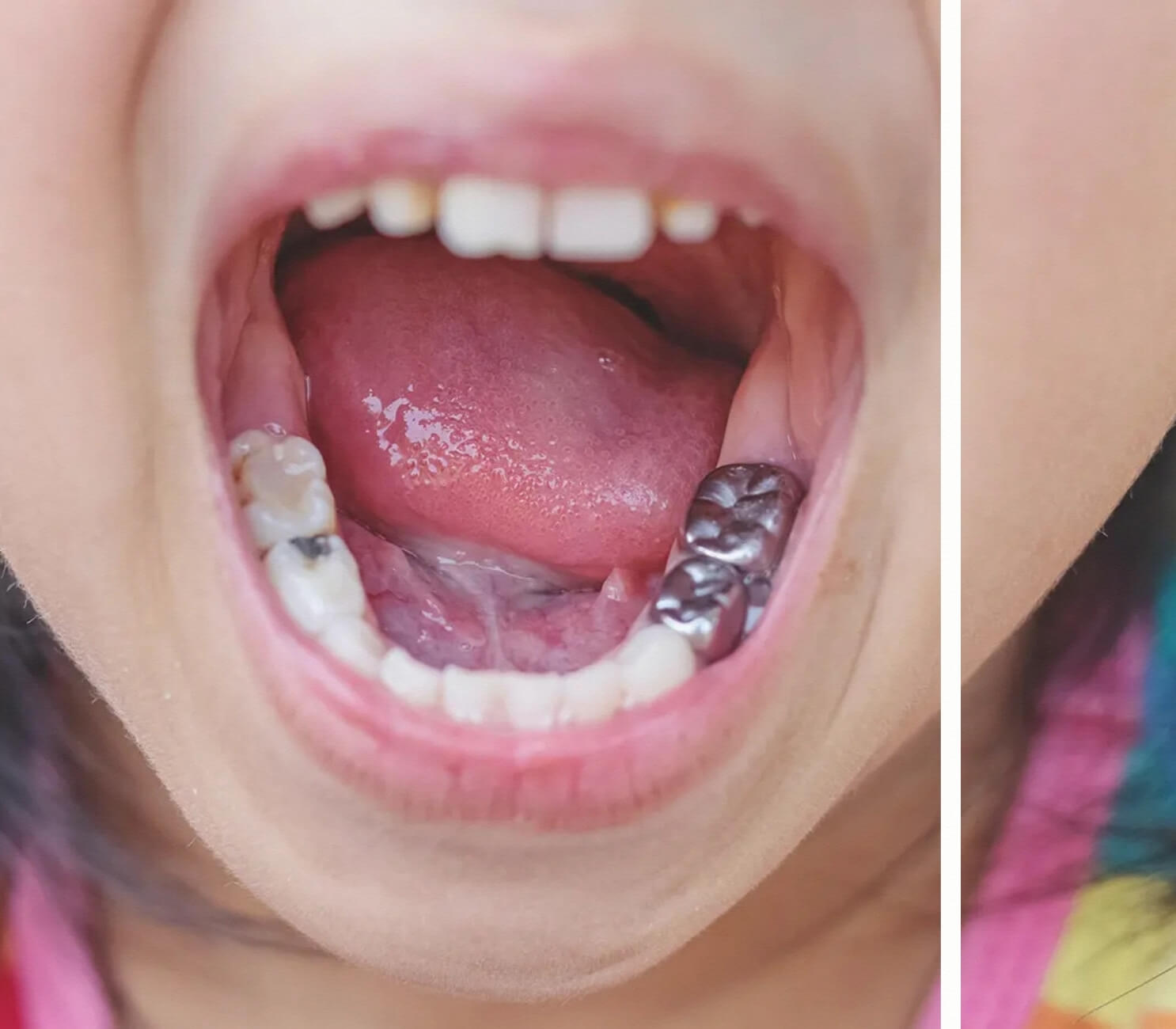 Paslanmaz Çelik Kron PÇK