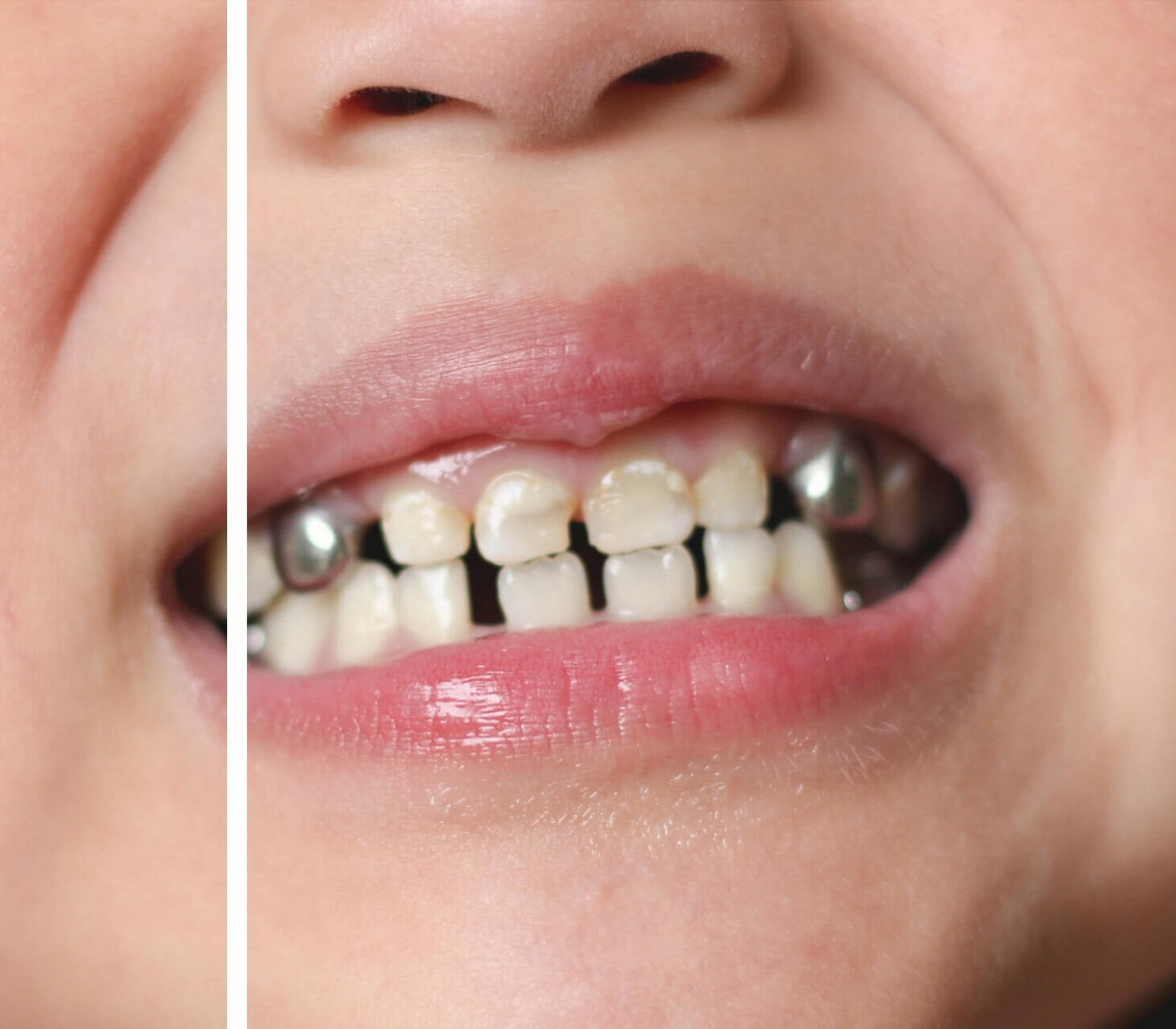 Paslanmaz Çelik Kron