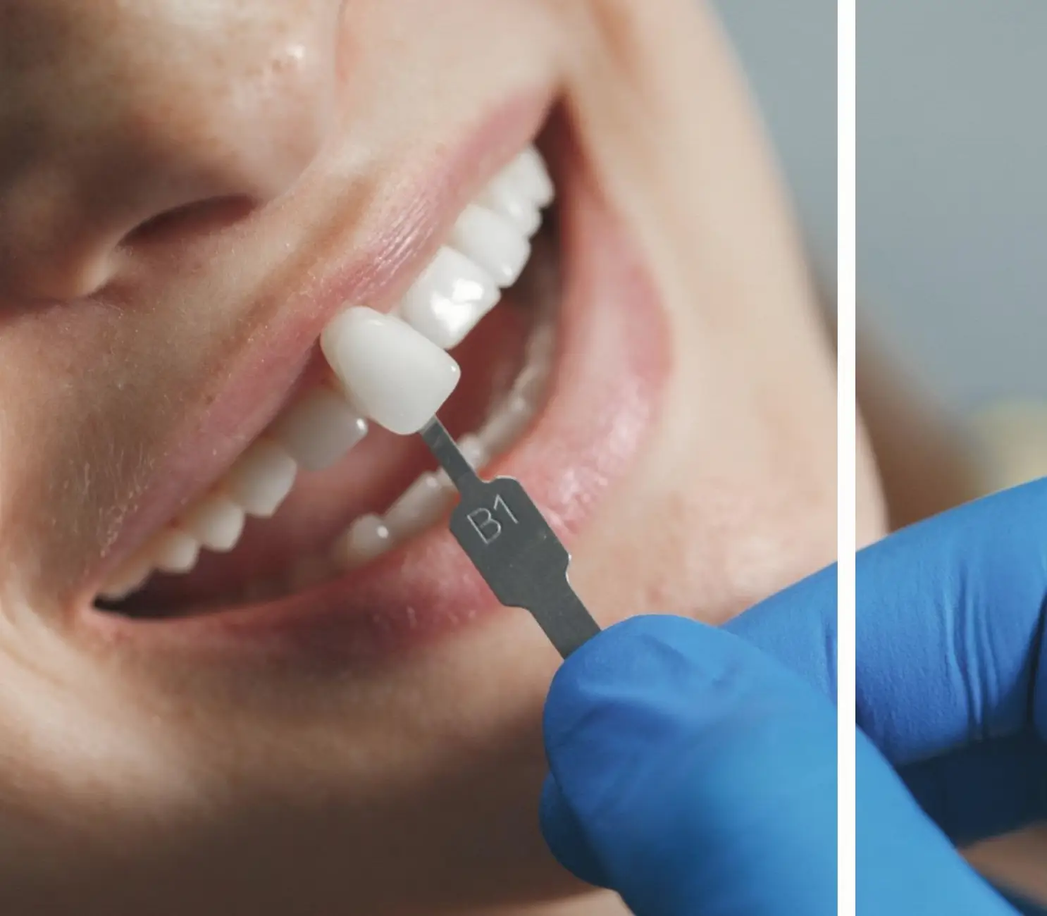 Porselen Kaplama Renk Seçimi