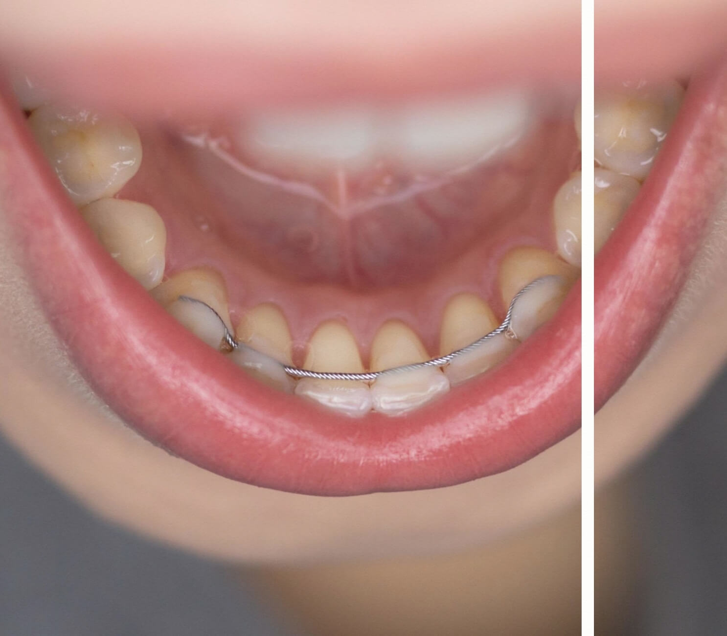 Retainer Teli Alt Çene