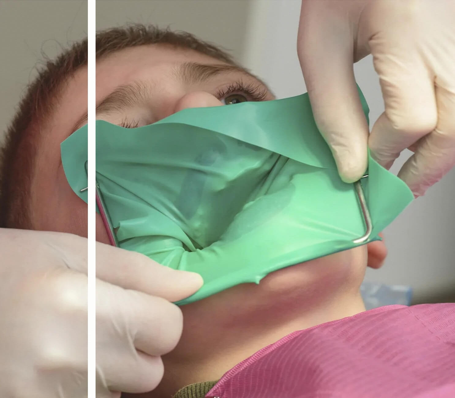 Süt Dİşi Amputasyon