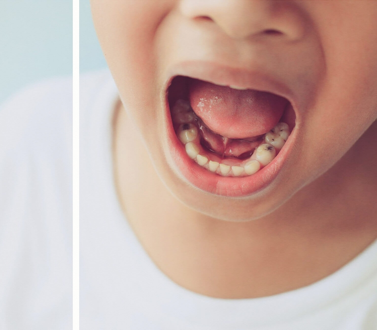 Süt Dişi Kanal Tedavi