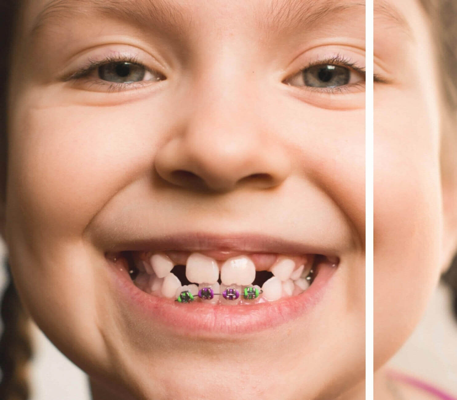 Süt Dişleri Olan Çocuk