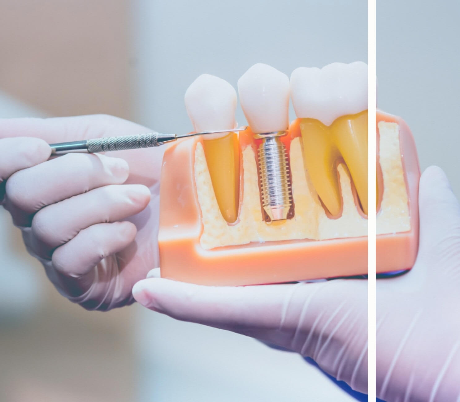 Doktor implant modeli gösteriyor.