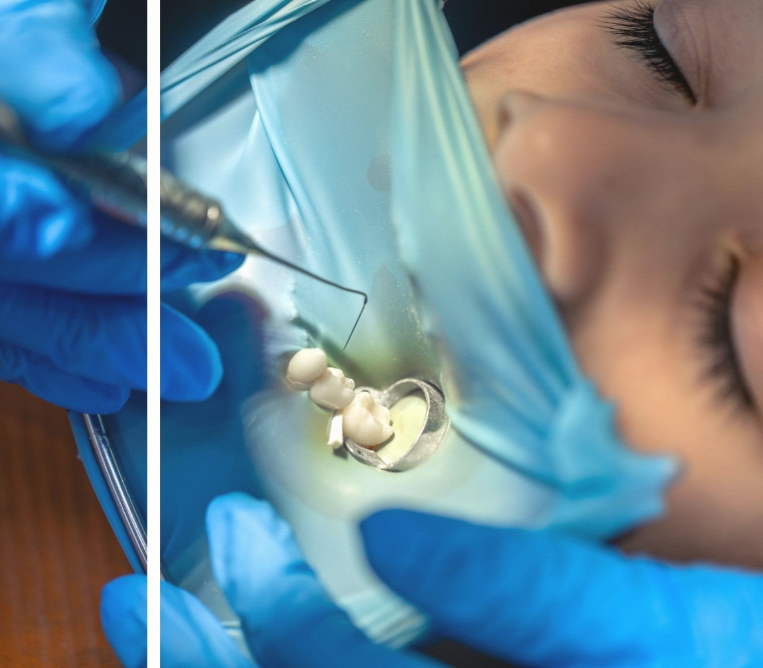 rubber dam ile diş dolgusu