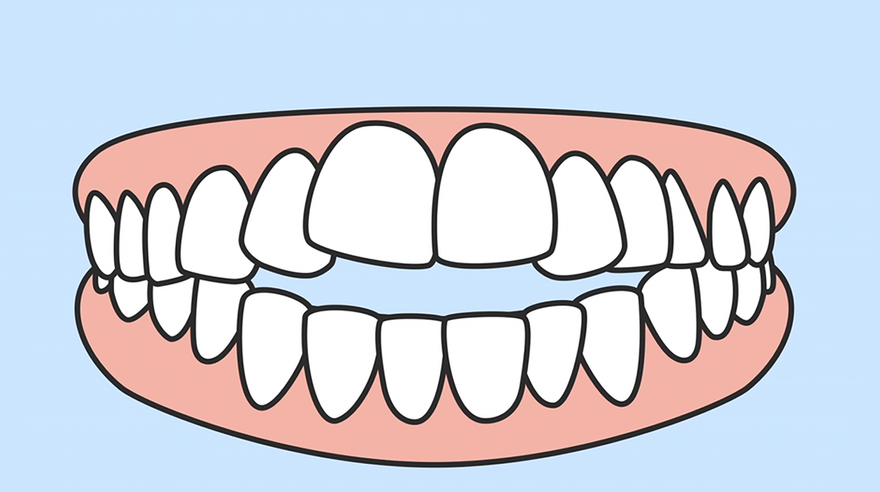 Yutkunurken Dilinizi Nereye Koyuyorsunuz? Yanlış Yutkunma ve Diş Bozukluğu