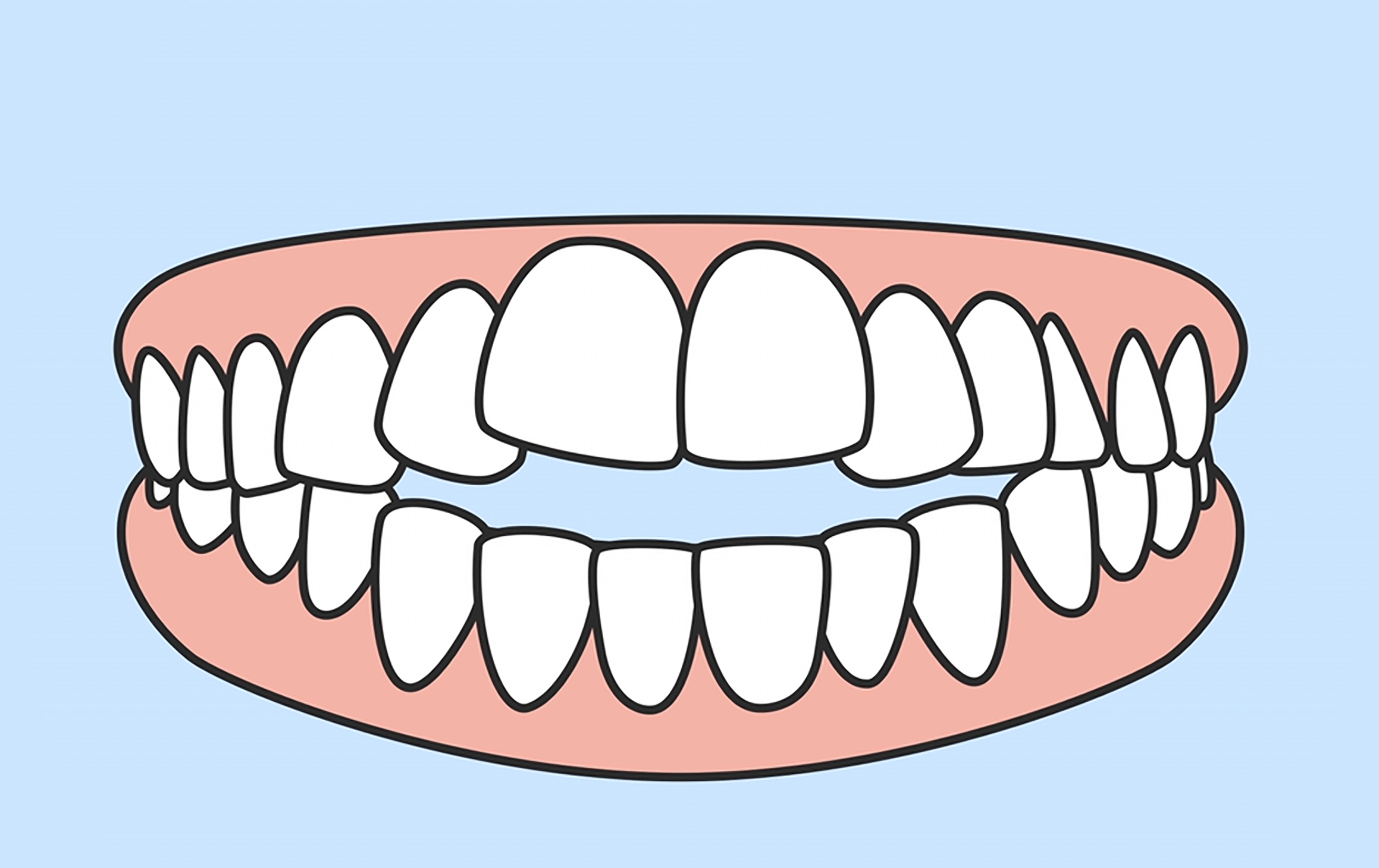 Yutkunurken Dilinizi Nereye Koyuyorsunuz? Yanlış Yutkunma ve Diş Bozukluğu