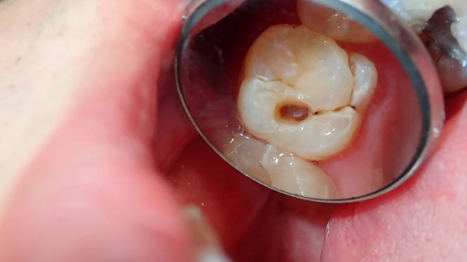 Dişiniz Çatladıysa Panik Yapmayın Ama Ertelemeyin