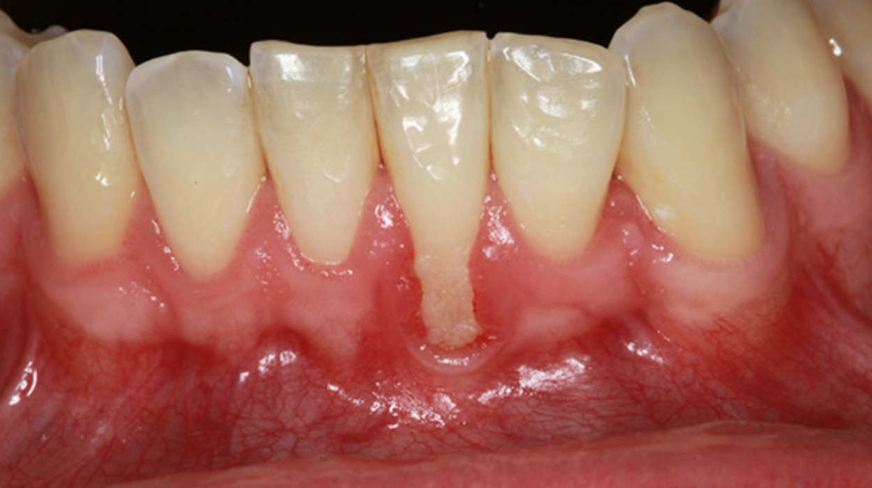 Diş Eti Çekilmesini Fark Ettiğinizde Çoktan Geç mi Kaldınız?