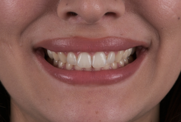 Örnek: Doğal Gülümseme