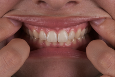 Örnek: Ön Kapanış