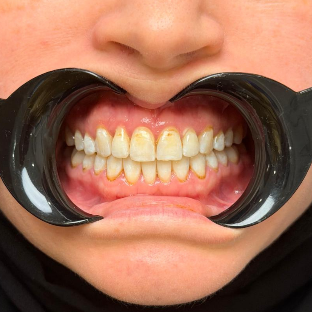 Açık kapanış (open bite) vakası — ortodonti tedavisi sonrası